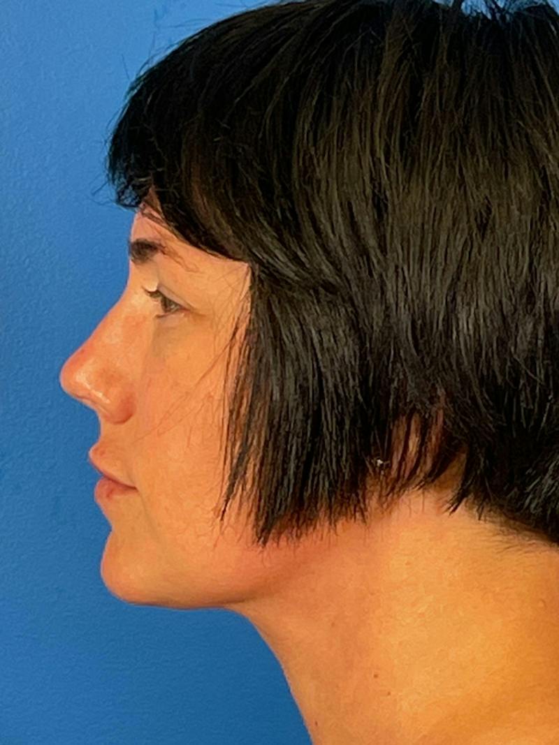 Liposuction Before & After Gallery - Patient 427117 - Image 6