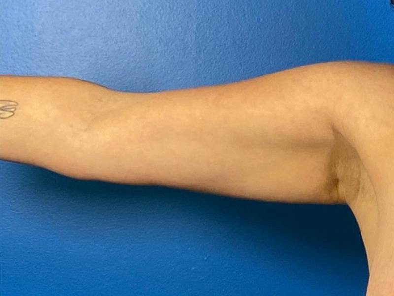 Liposuction Before & After Gallery - Patient 389040 - Image 1
