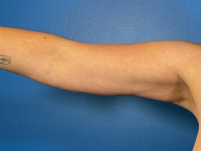 Liposuction Before & After Gallery - Patient 389040 - Image 2