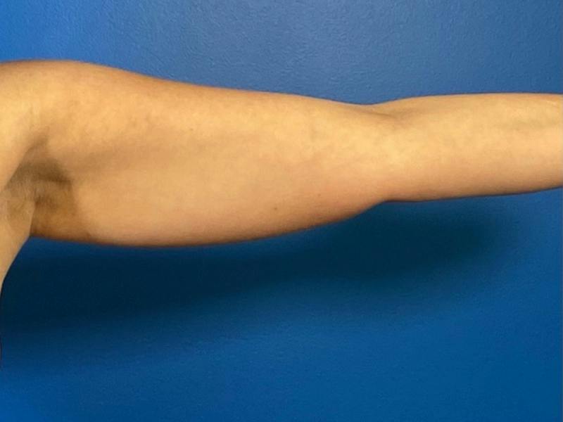 Liposuction Before & After Gallery - Patient 389040 - Image 3