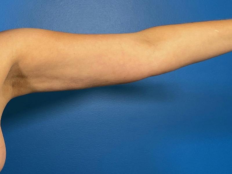 Liposuction Before & After Gallery - Patient 389040 - Image 4