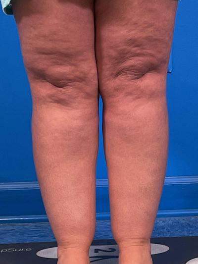 Liposuction Before & After Gallery - Patient 406765 - Image 1