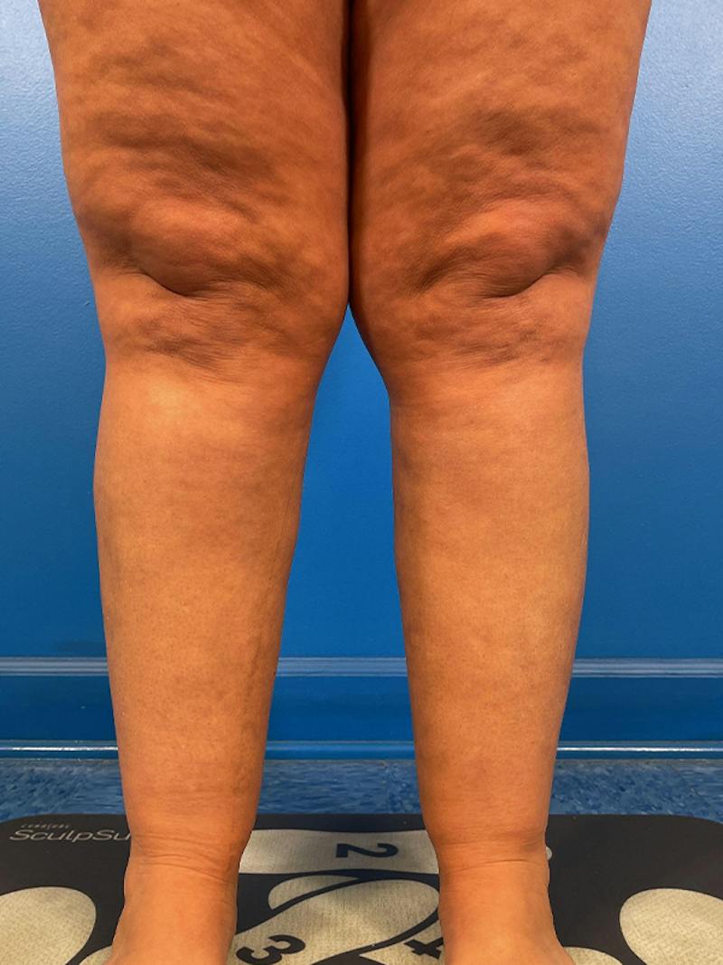 Liposuction Before & After Gallery - Patient 406765 - Image 2