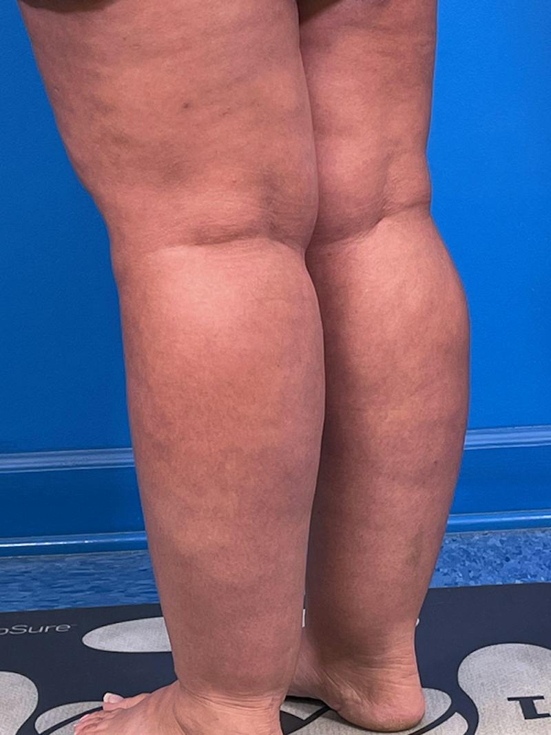Liposuction Before & After Gallery - Patient 406765 - Image 3