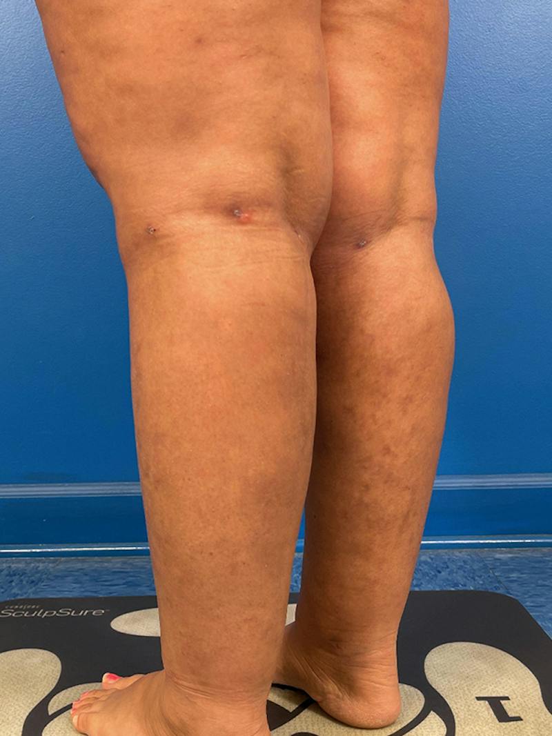 Liposuction Before & After Gallery - Patient 406765 - Image 4