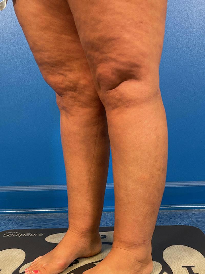 Liposuction Before & After Gallery - Patient 406765 - Image 6