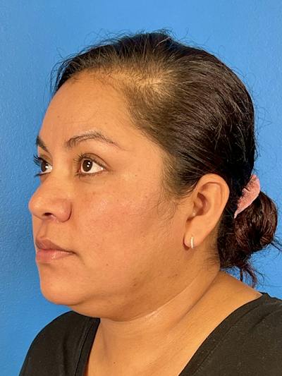 Liposuction Before & After Gallery - Patient 325768 - Image 1
