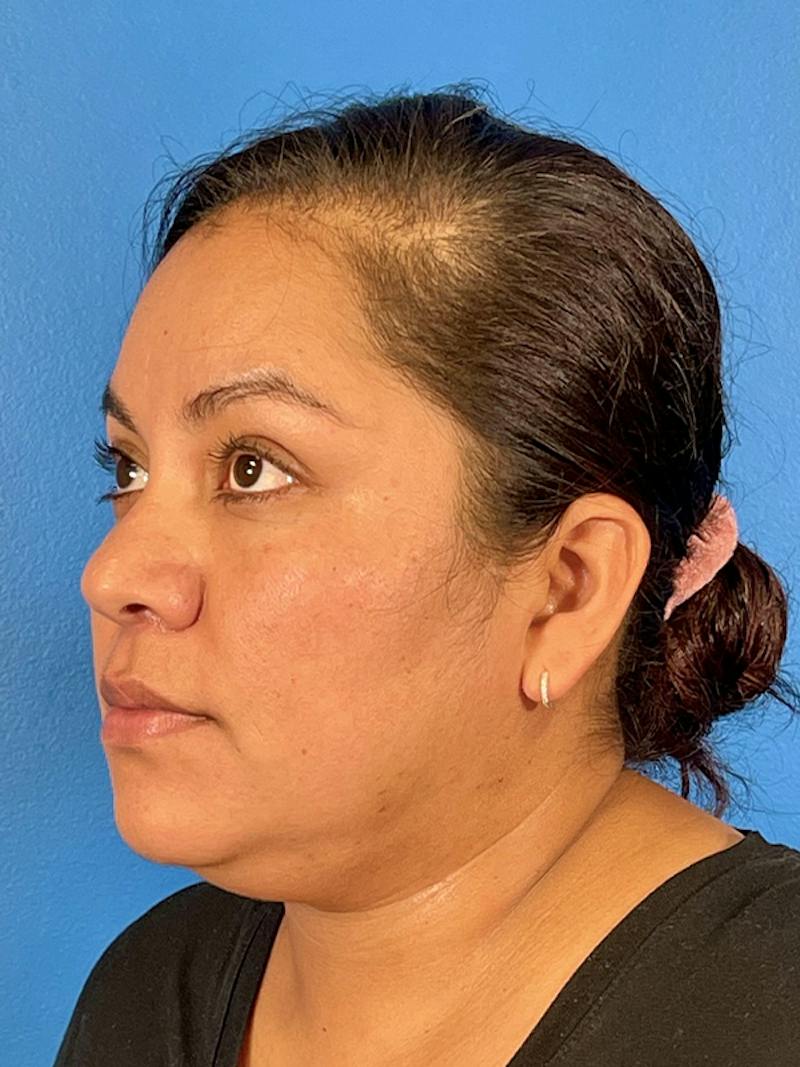 Liposuction Before & After Gallery - Patient 325768 - Image 1