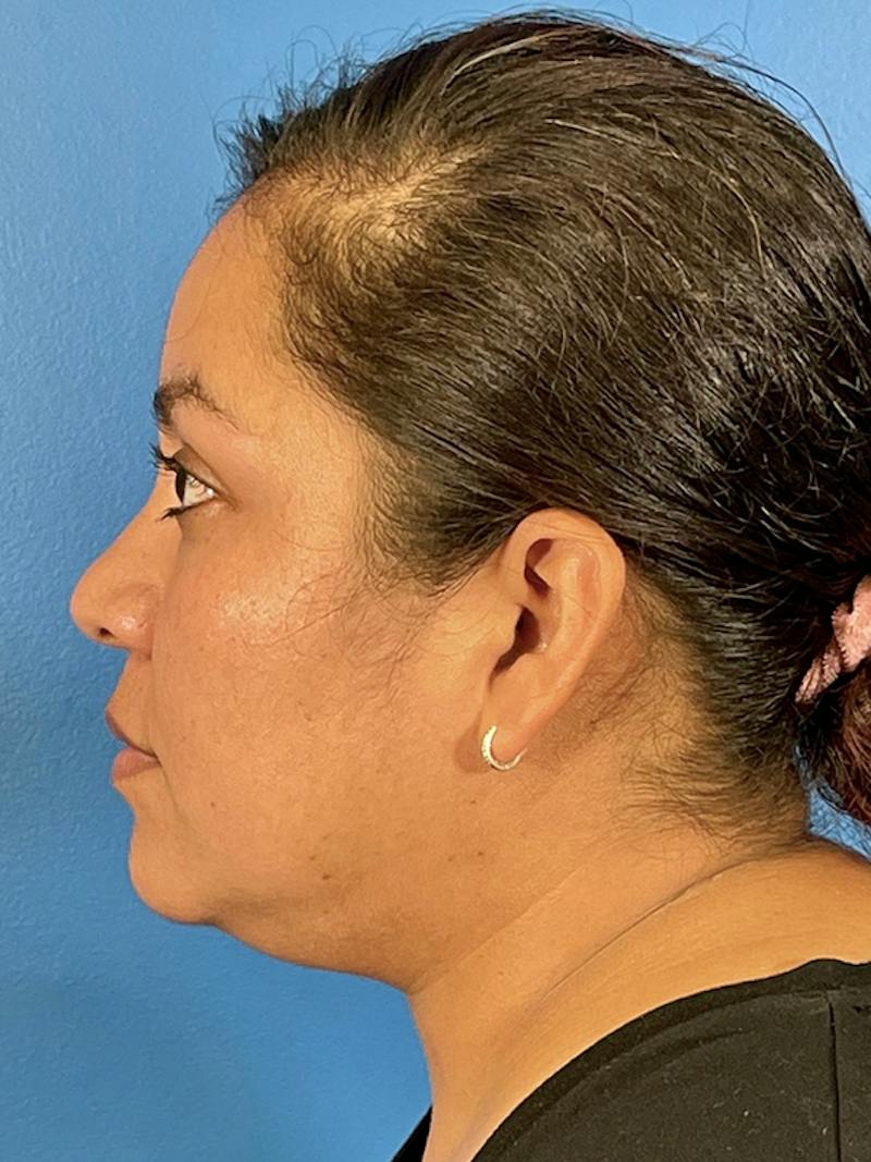 Liposuction Before & After Gallery - Patient 325768 - Image 3