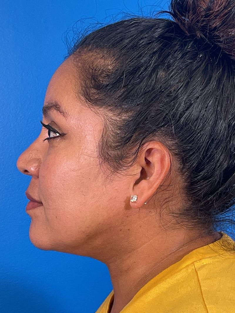 Liposuction Before & After Gallery - Patient 325768 - Image 4