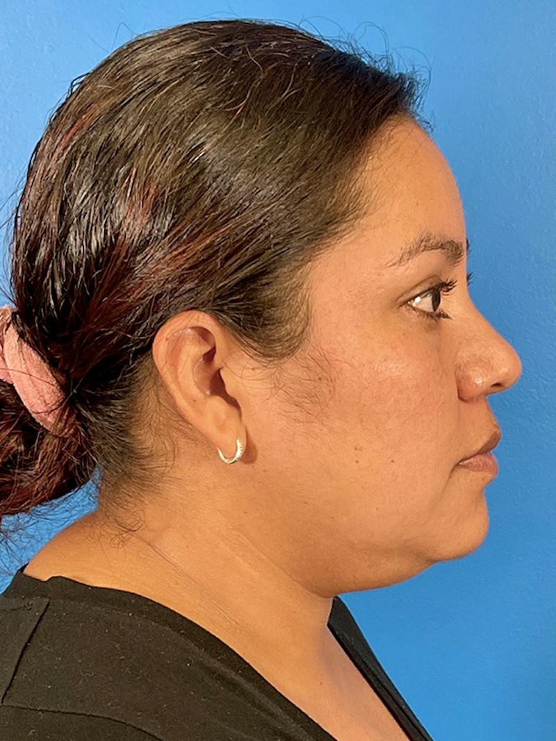 Liposuction Before & After Gallery - Patient 325768 - Image 5