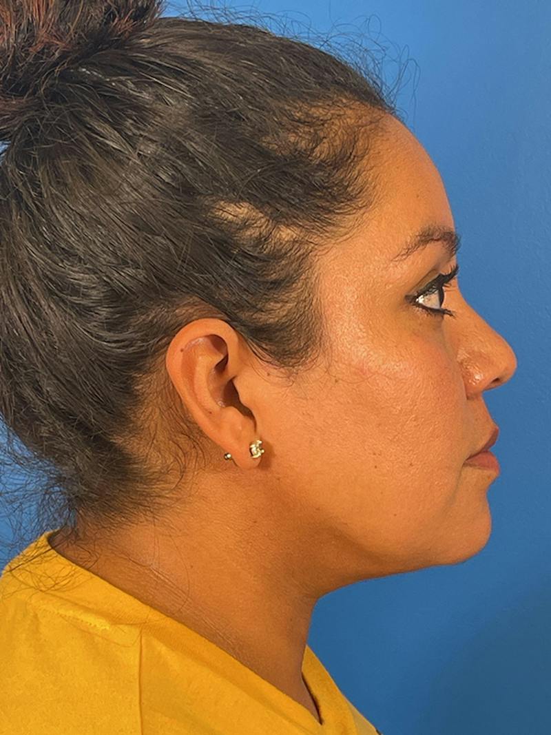Liposuction Before & After Gallery - Patient 325768 - Image 6