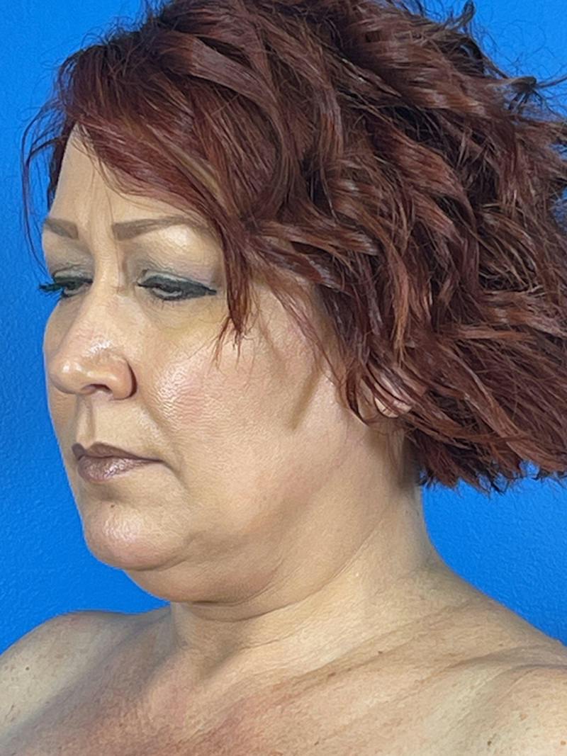 Liposuction Before & After Gallery - Patient 377783 - Image 1