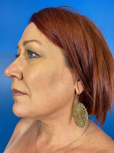 Liposuction Before & After Gallery - Patient 377783 - Image 2