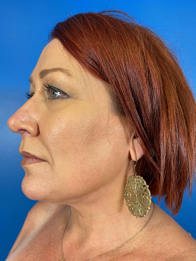Liposuction Before & After Gallery - Patient 377783 - Image 2