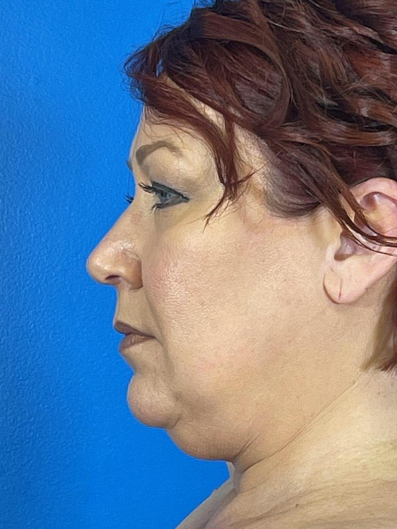 Liposuction Before & After Gallery - Patient 377783 - Image 3