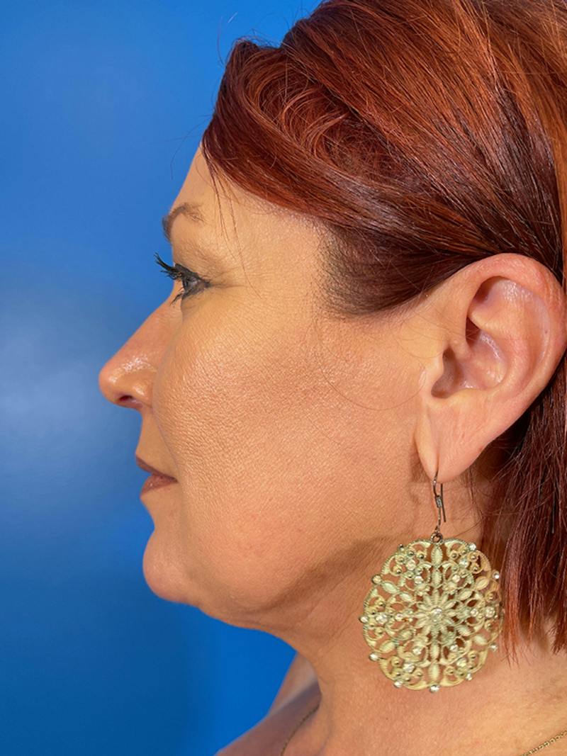 Liposuction Before & After Gallery - Patient 377783 - Image 4