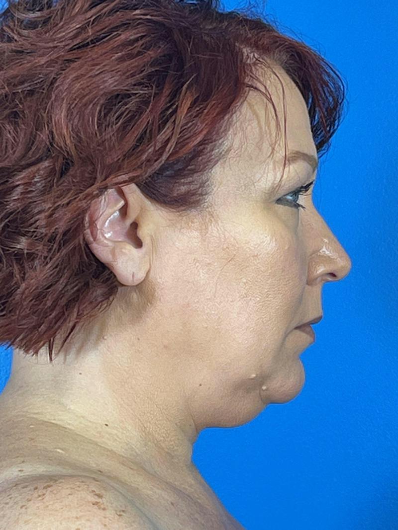 Liposuction Before & After Gallery - Patient 377783 - Image 5
