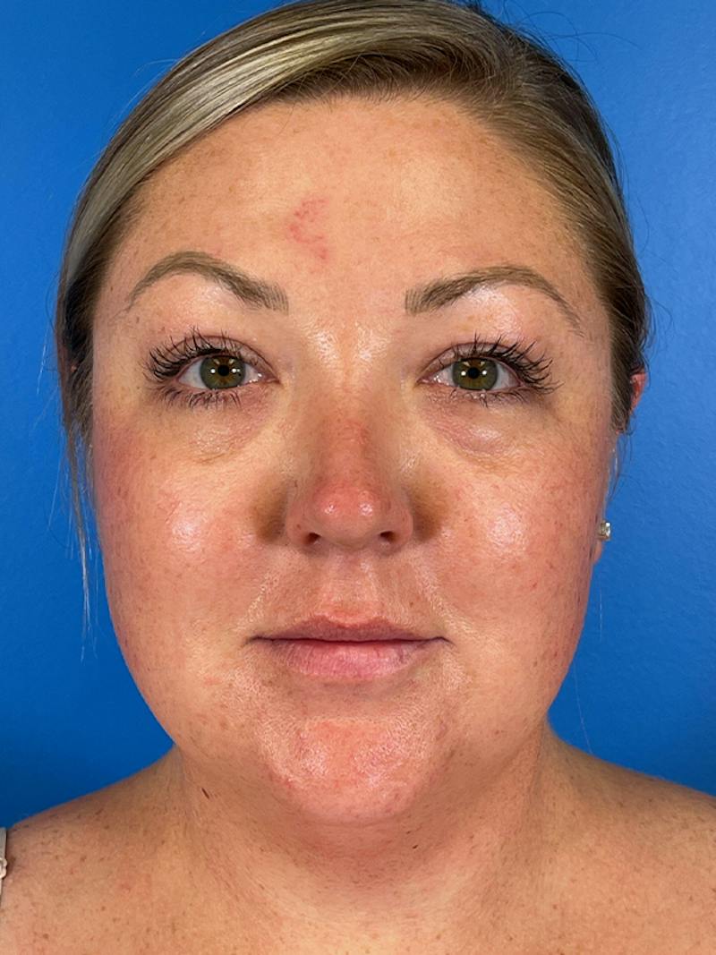 Liposuction Before & After Gallery - Patient 175874 - Image 1