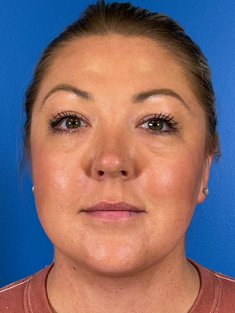 Liposuction Before & After Gallery - Patient 175874 - Image 2