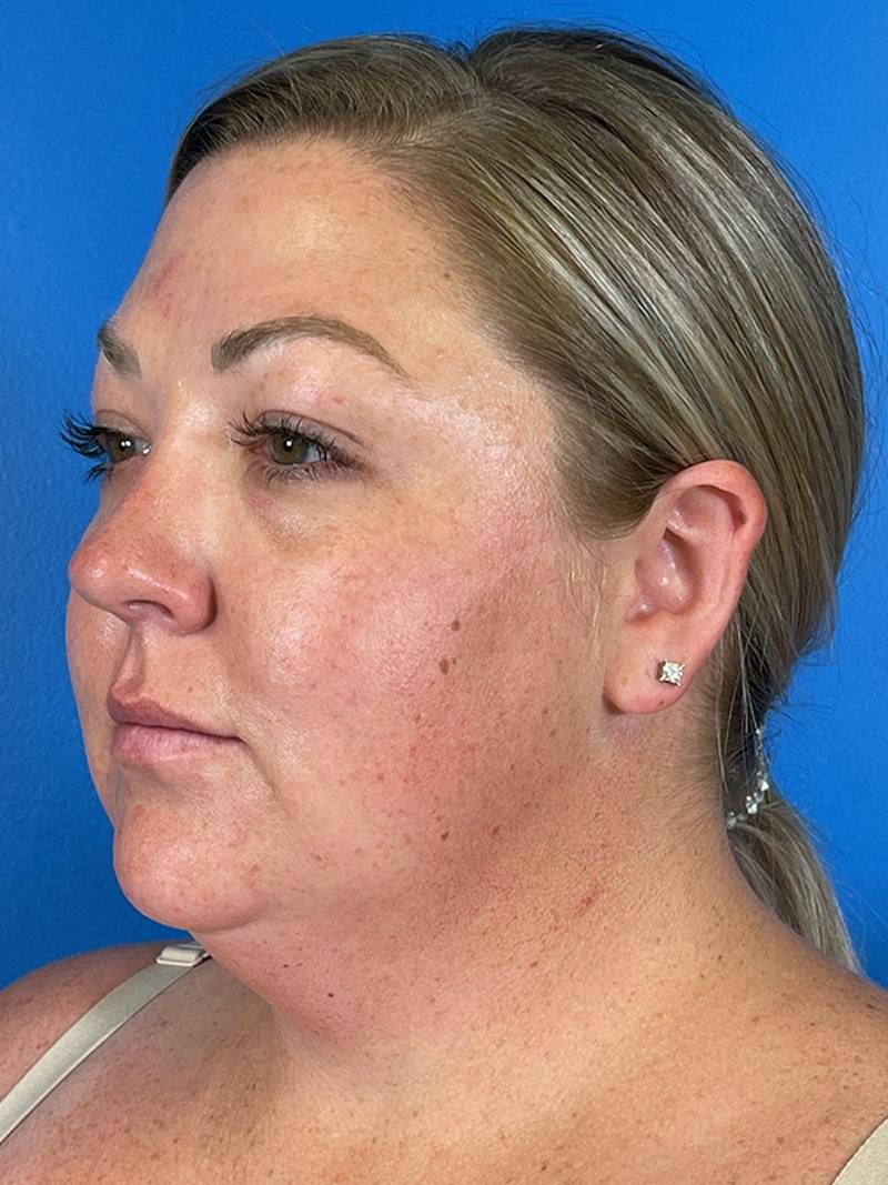 Liposuction Before & After Gallery - Patient 175874 - Image 3