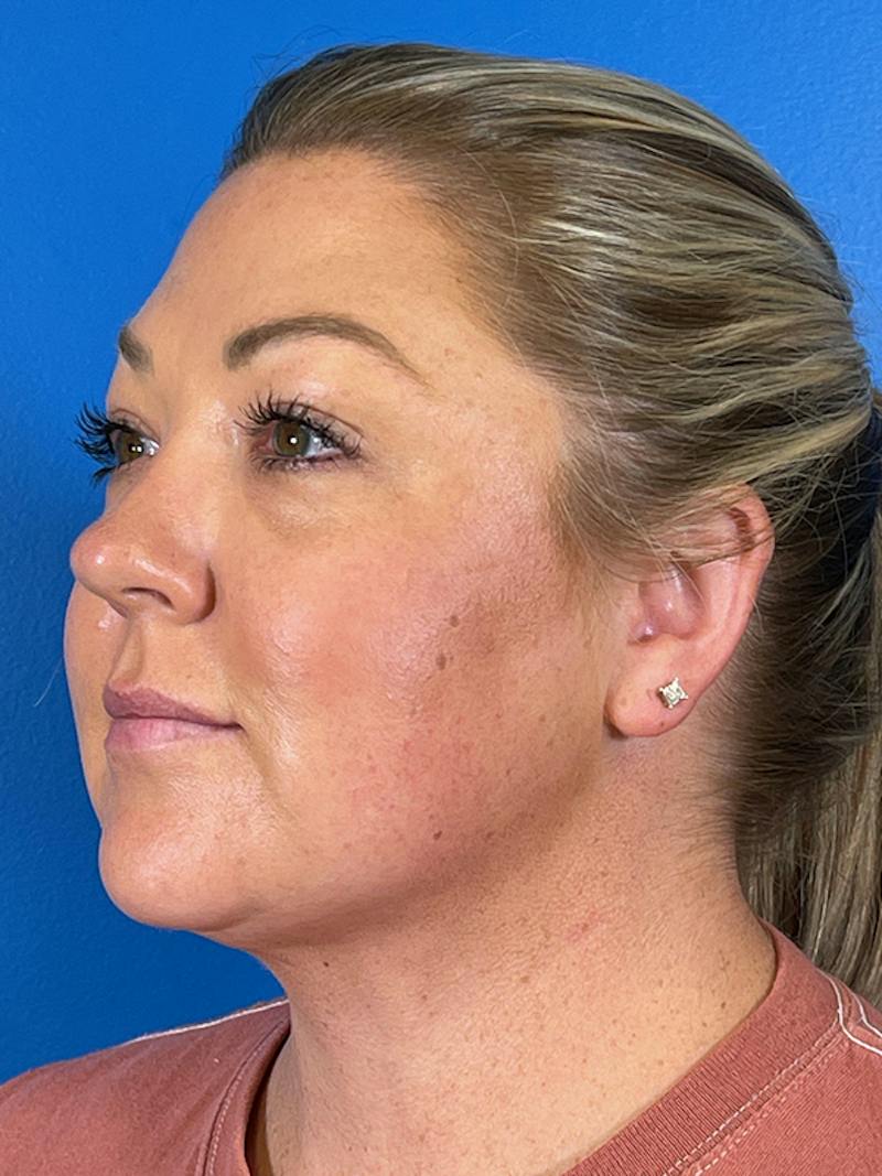 Liposuction Before & After Gallery - Patient 175874 - Image 4