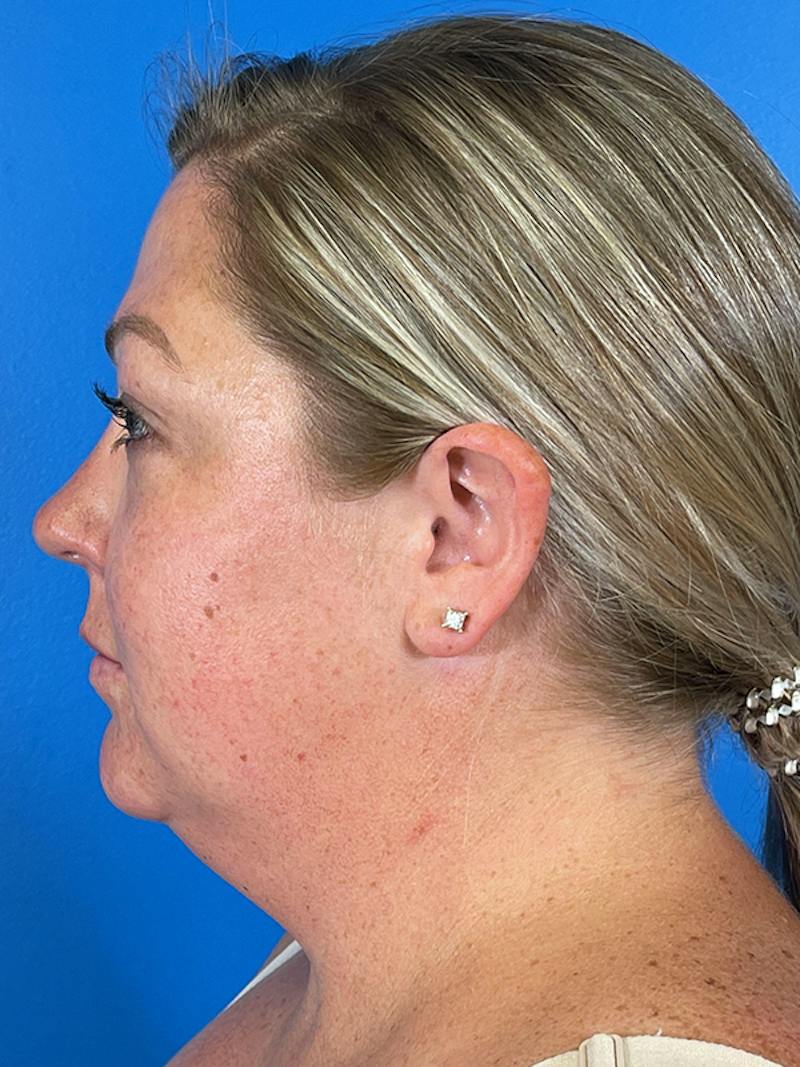 Liposuction Before & After Gallery - Patient 175874 - Image 5