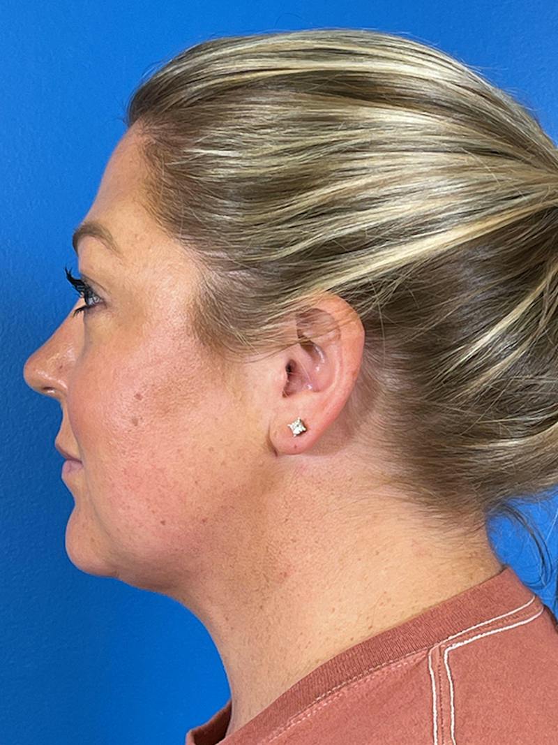 Liposuction Before & After Gallery - Patient 175874 - Image 6
