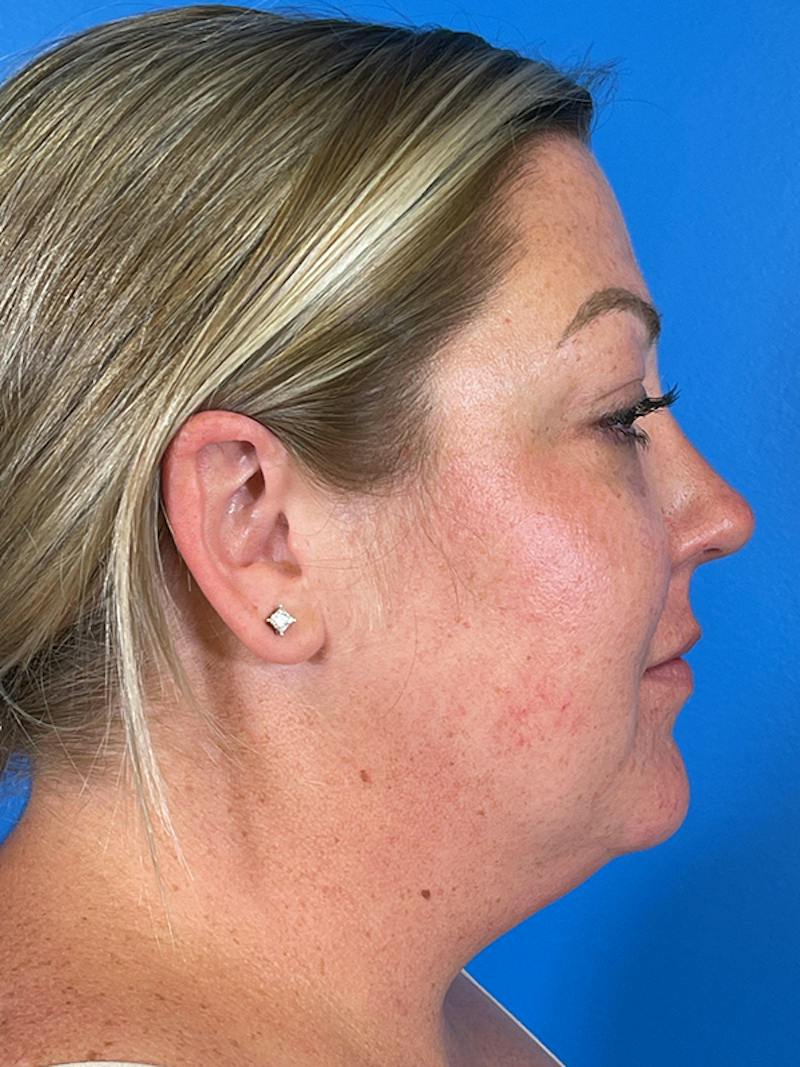 Liposuction Before & After Gallery - Patient 175874 - Image 7