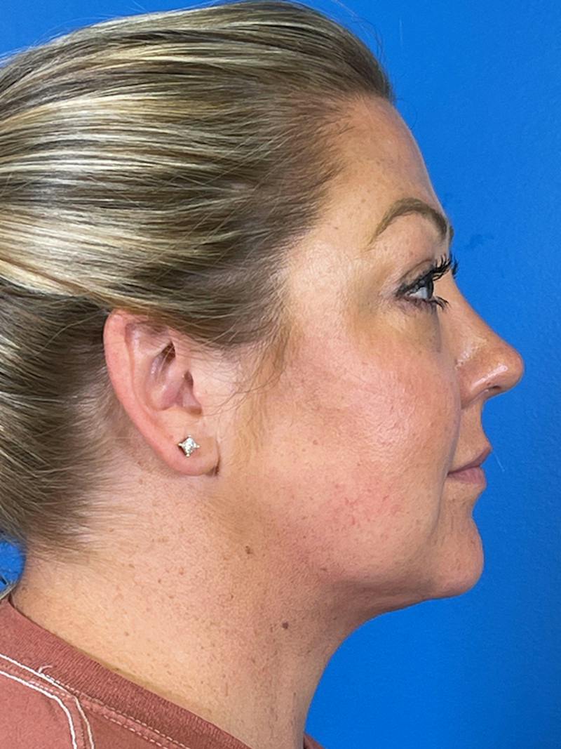 Liposuction Before & After Gallery - Patient 175874 - Image 8