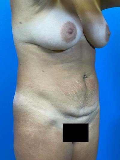 Mommy Makeover Before & After Gallery - Patient 504362 - Image 1