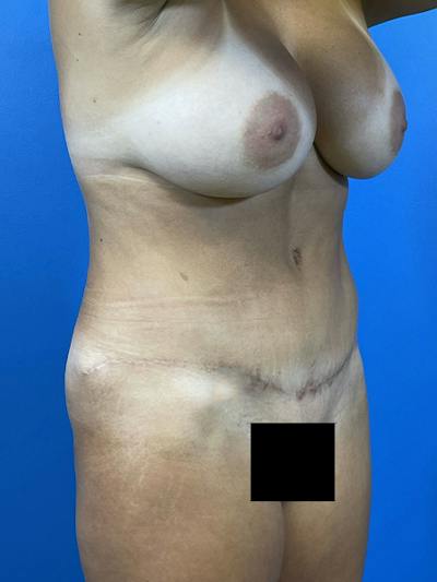 Mommy Makeover Before & After Gallery - Patient 504362 - Image 2
