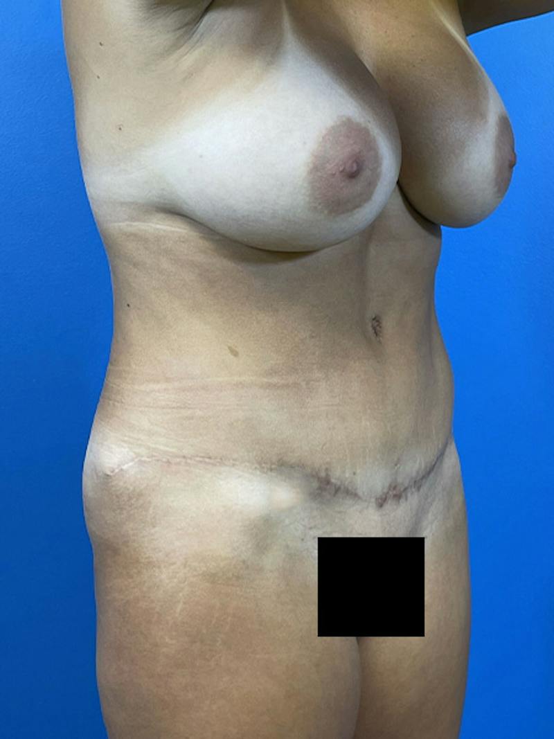 Mommy Makeover Before & After Gallery - Patient 504362 - Image 2