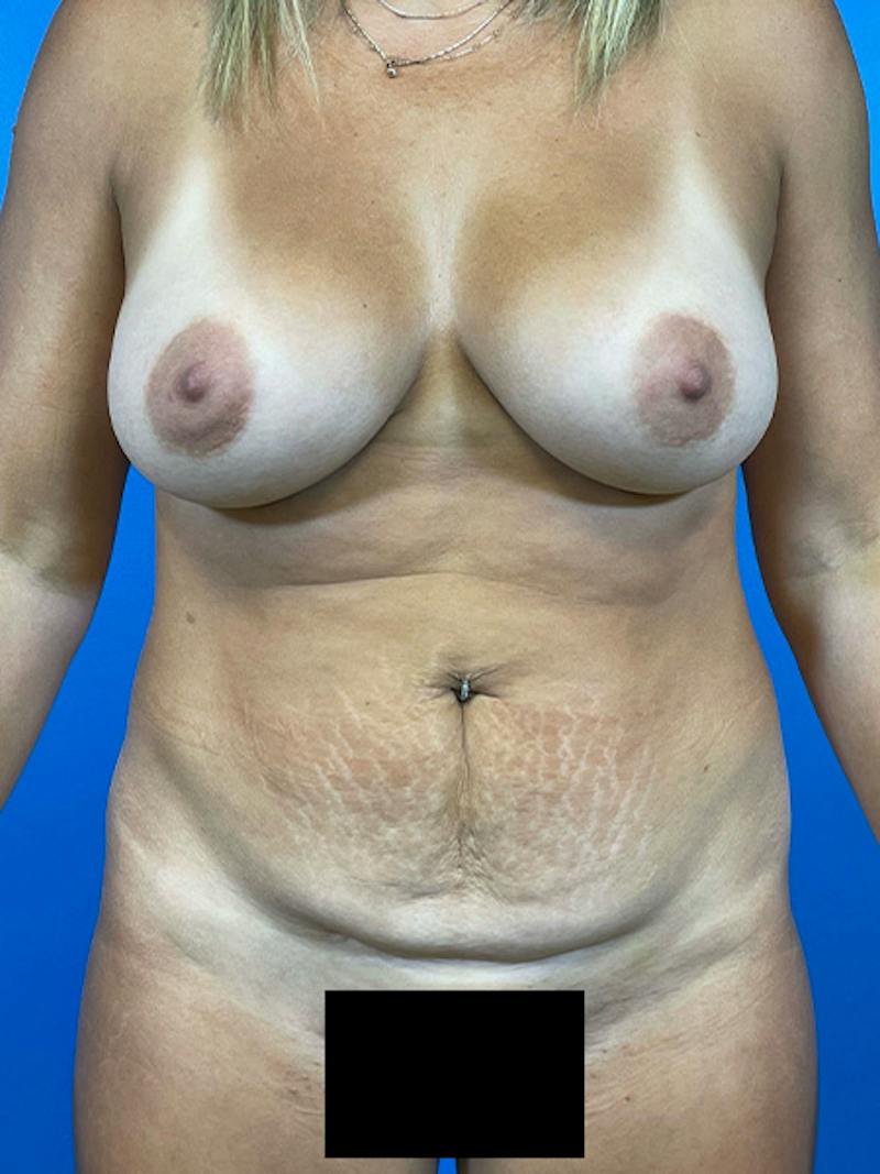 Mommy Makeover Before & After Gallery - Patient 504362 - Image 5