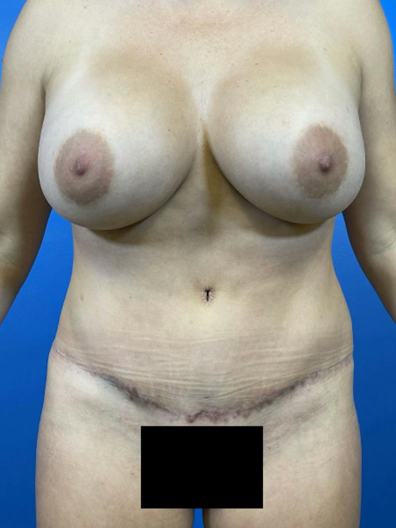 Mommy Makeover Before & After Gallery - Patient 504362 - Image 6