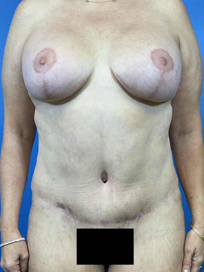 Mommy Makeover Before & After Gallery - Patient 124325 - Image 2