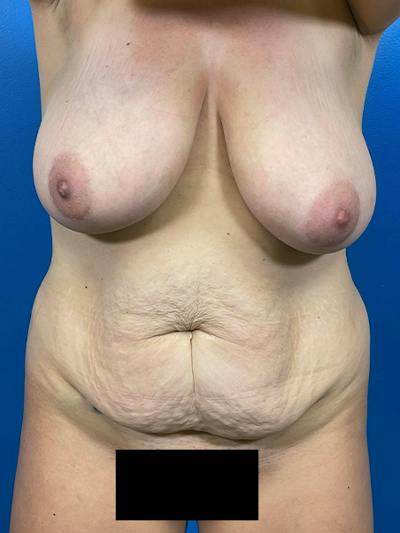 Mommy Makeover Before & After Gallery - Patient 369975 - Image 1