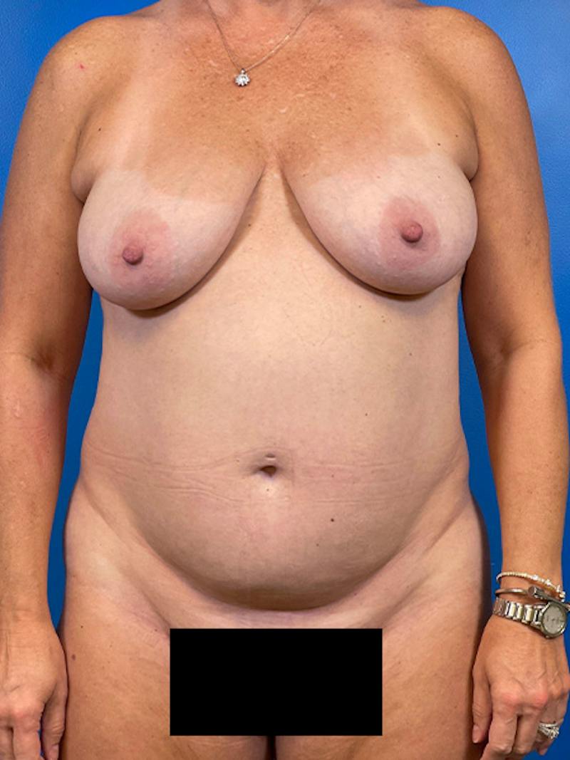 Mommy Makeover Before & After Gallery - Patient 377816 - Image 1