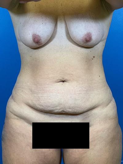 Mommy Makeover Before & After Gallery - Patient 184098 - Image 1