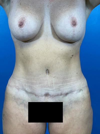Mommy Makeover Before & After Gallery - Patient 184098 - Image 2