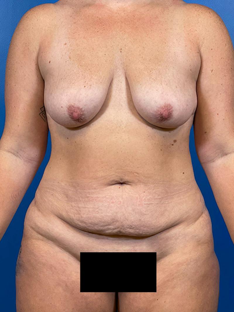 Mommy Makeover Before & After Gallery - Patient 184098 - Image 3