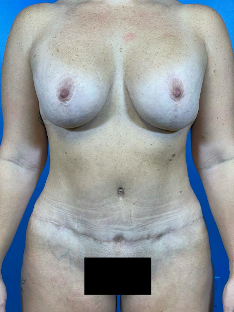 Mommy Makeover Before & After Gallery - Patient 184098 - Image 4