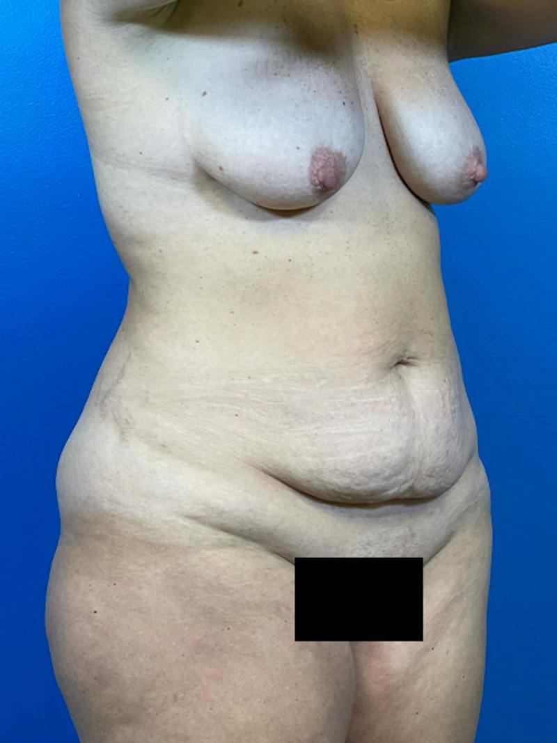 Mommy Makeover Before & After Gallery - Patient 184098 - Image 5