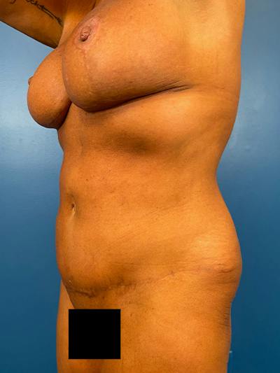 Mommy Makeover Before & After Gallery - Patient 298594 - Image 2