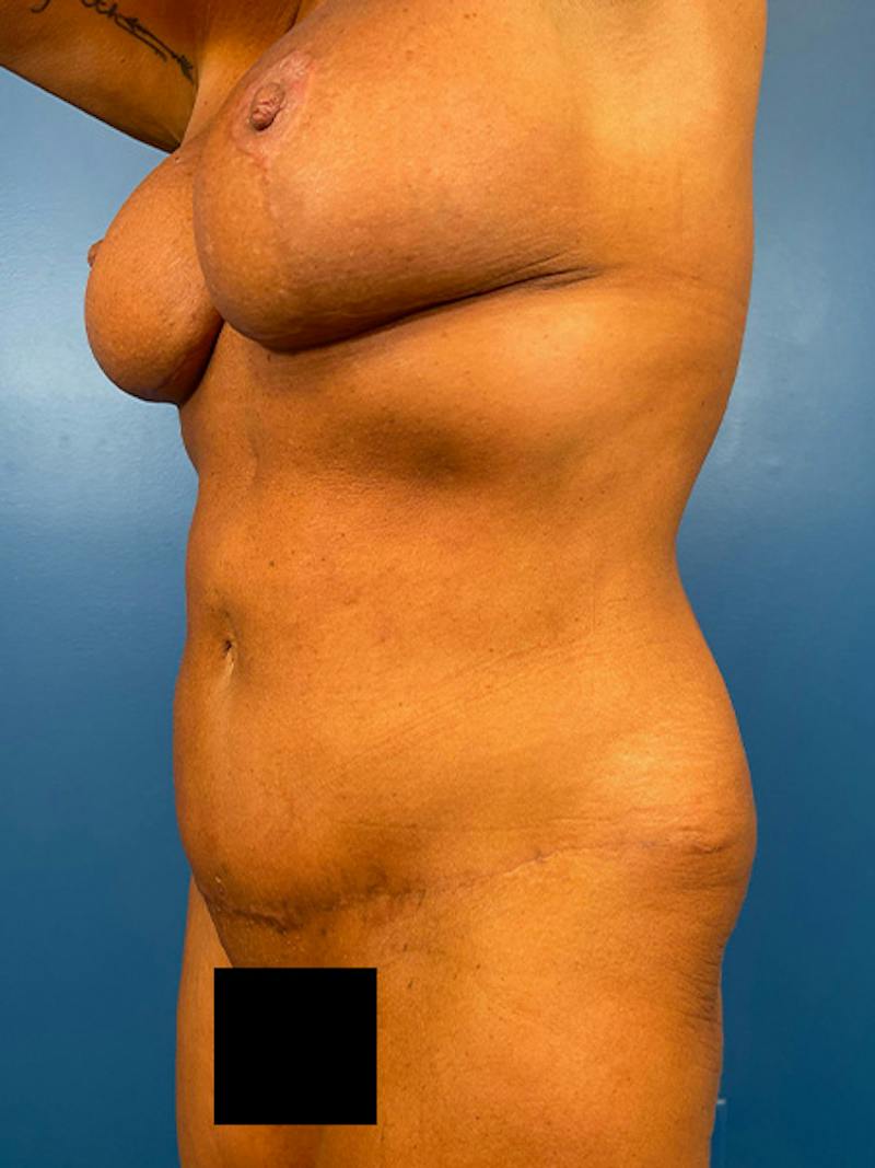 Mommy Makeover Before & After Gallery - Patient 298594 - Image 2