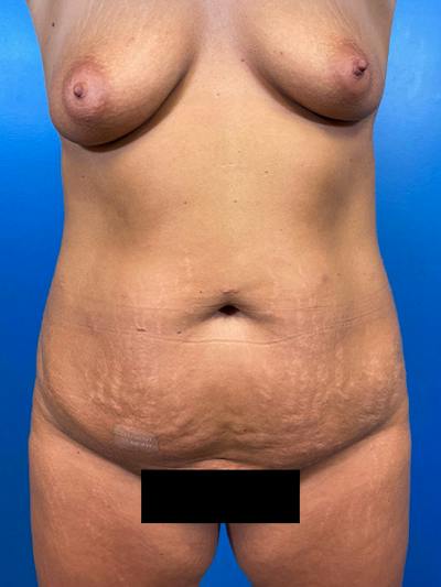 Mommy Makeover Before & After Gallery - Patient 423890 - Image 1