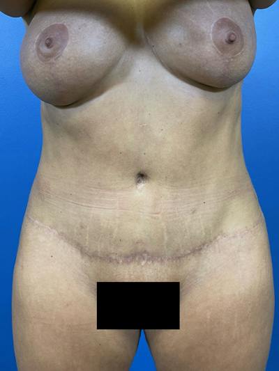 Mommy Makeover Before & After Gallery - Patient 423890 - Image 2