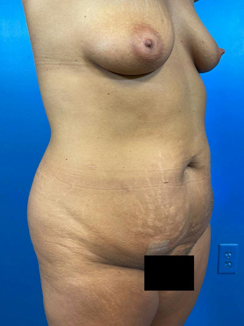 Mommy Makeover Before & After Gallery - Patient 423890 - Image 3