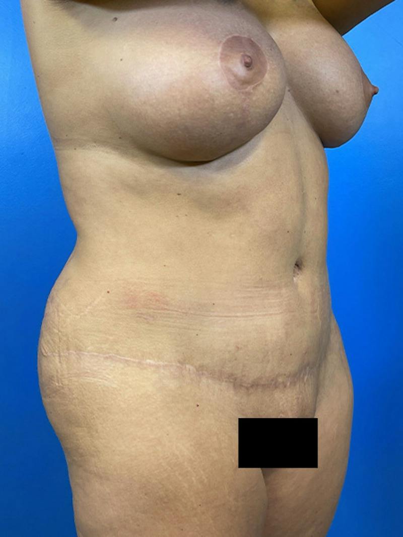 Mommy Makeover Before & After Gallery - Patient 423890 - Image 4