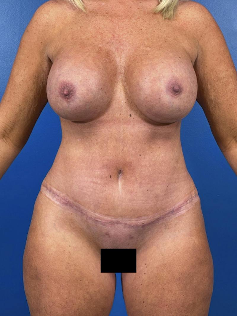 Mommy Makeover Before & After Gallery - Patient 220242 - Image 2